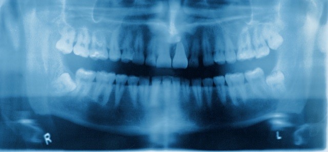 Dental X-Ray Treatment in Scripps Ranch