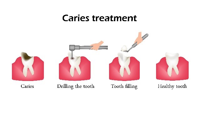 Dental Caries Treatment in Scripps Ranch