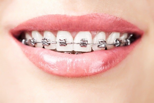 Lake Erie Dental Blog  Clear Braces for a Modern Approach to Straight Teeth