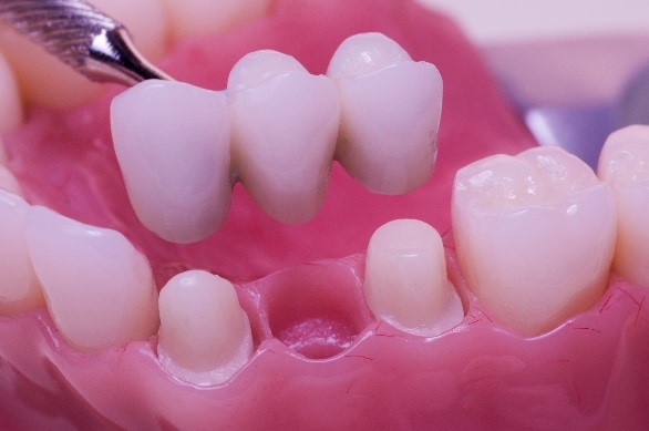 Dental Bridge Placement in Scripps Ranch