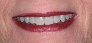 Custom Smile Desing in Scripps Ranch