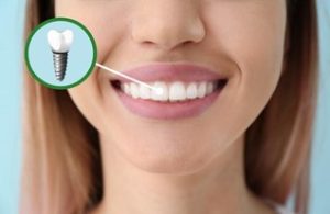 Cosmetic Dental Implants San Diego, CA