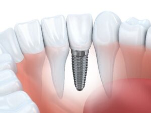 Dental Implants in Poway