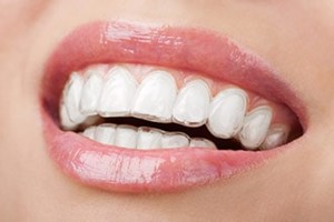 Invisalign & ClearCorrect in Sabre Springs