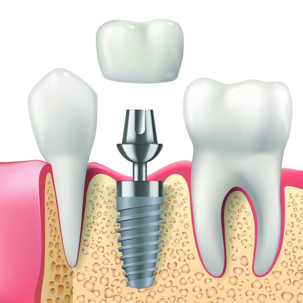 Dental Implants San Diego Dentist