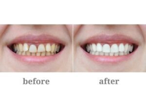 Smile Design in Rancho Peñasquitos