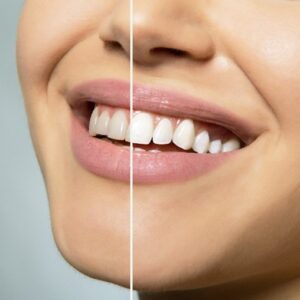 Teeth Whitening in Mira Mesa